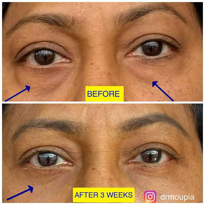 before and after lower lid blepharoplasty (2)