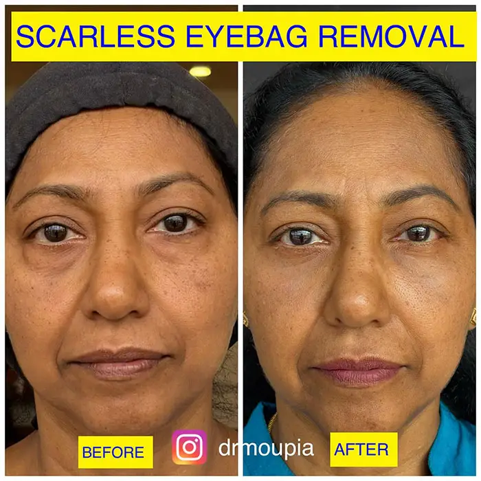 before and after lower lid blepharoplasty