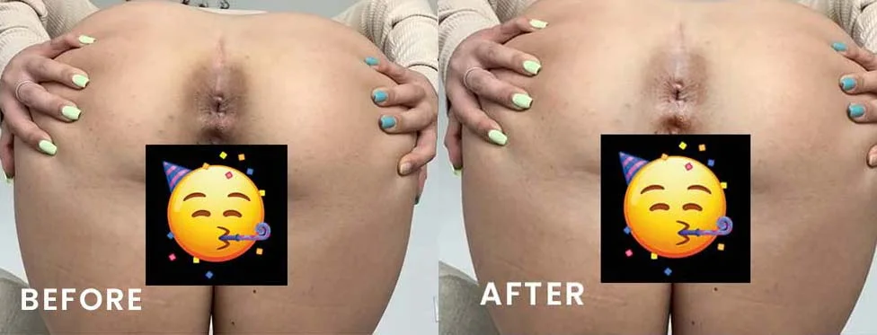 bleached anuses before and after