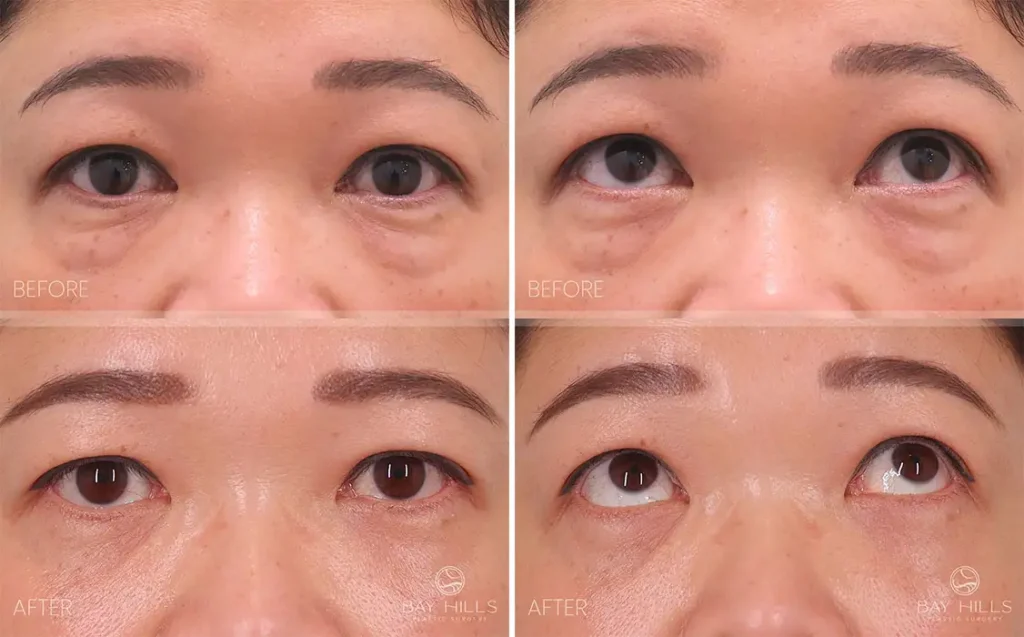 blepharoplasty before and after asian (4)