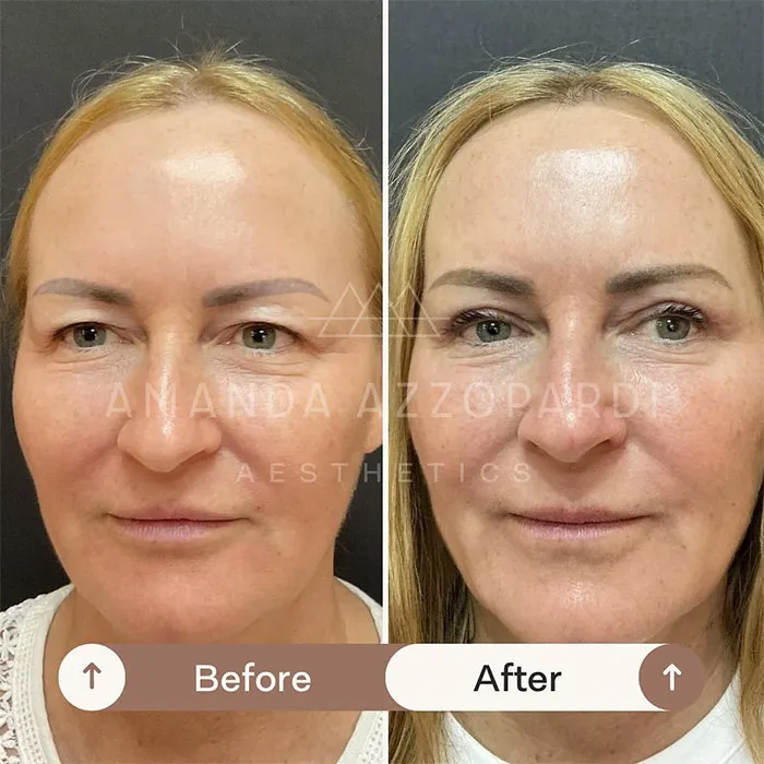 blepharoplasty before and after asian (5)