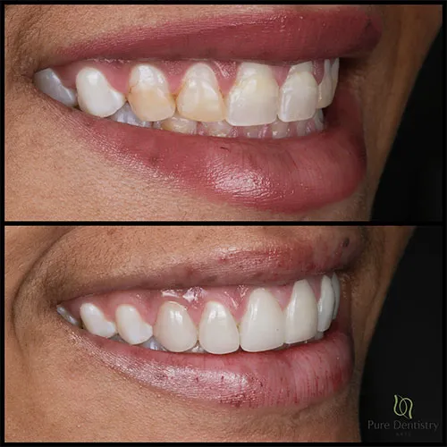 dental veneers before and after transformation (1)