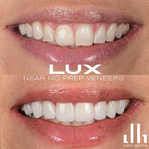 dental veneers before and after transformation (2)