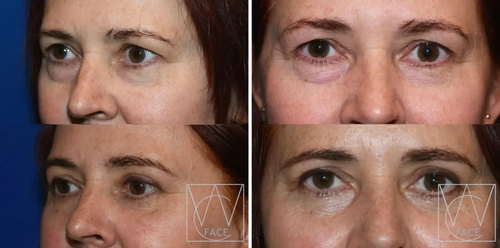 four months post lower and upper eyelid surgery.