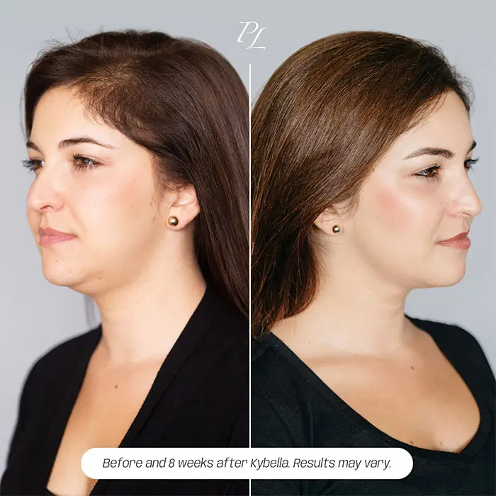 kybella before and after chin (1)