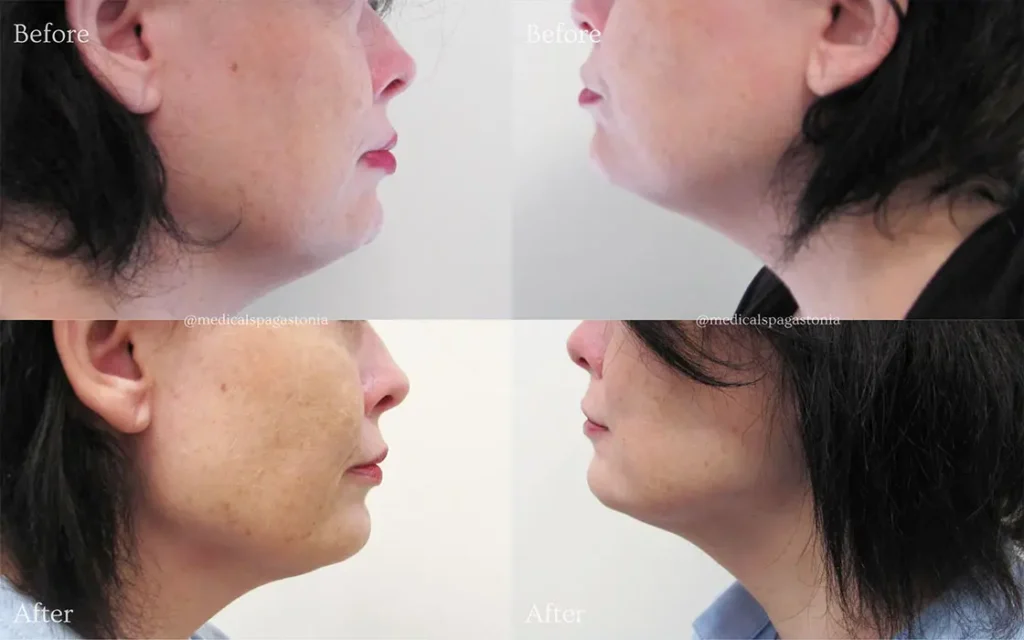kybella before and after chin (3)