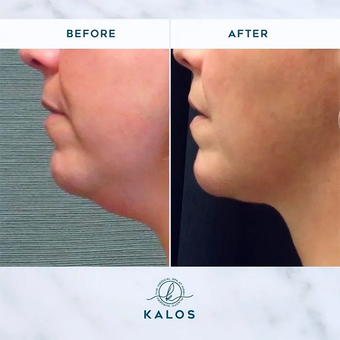 kybella before and after chin (4)