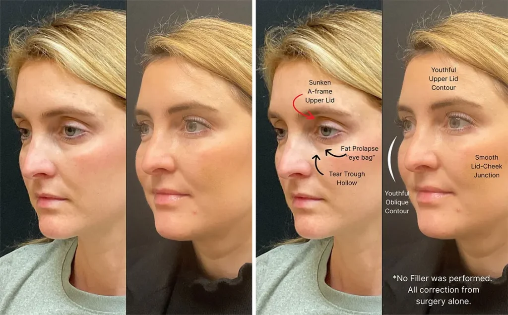 lower, Upper blepharoplasty recovery photos girl