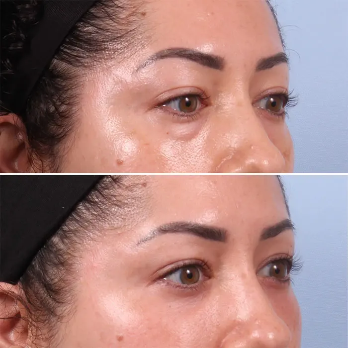 lower blepharoplasty before and after women (1)