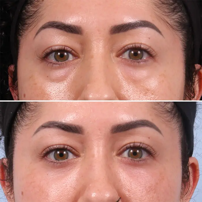 lower blepharoplasty before and after women (2)