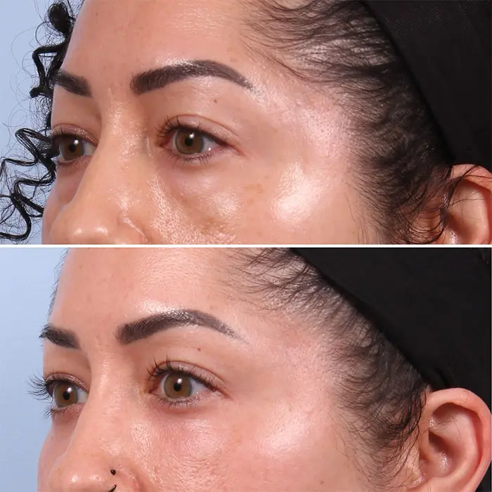 lower blepharoplasty before and after women (3)