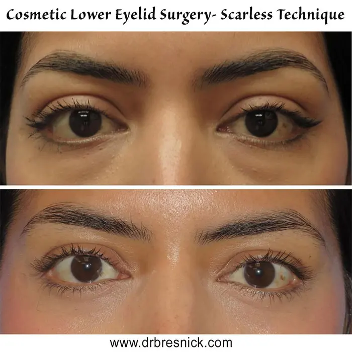 lower blepharoplasty before and after women