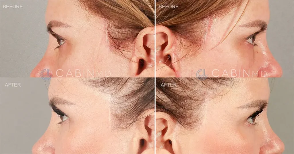 one year out from a two-stage approach blepharoplasty (1)