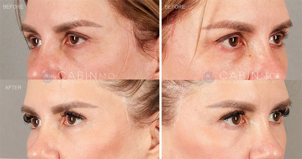 one year out from a two-stage approach blepharoplasty (2)