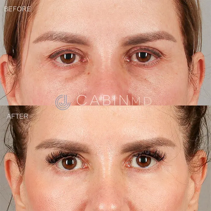 one year out from a two-stage approach blepharoplasty (3)