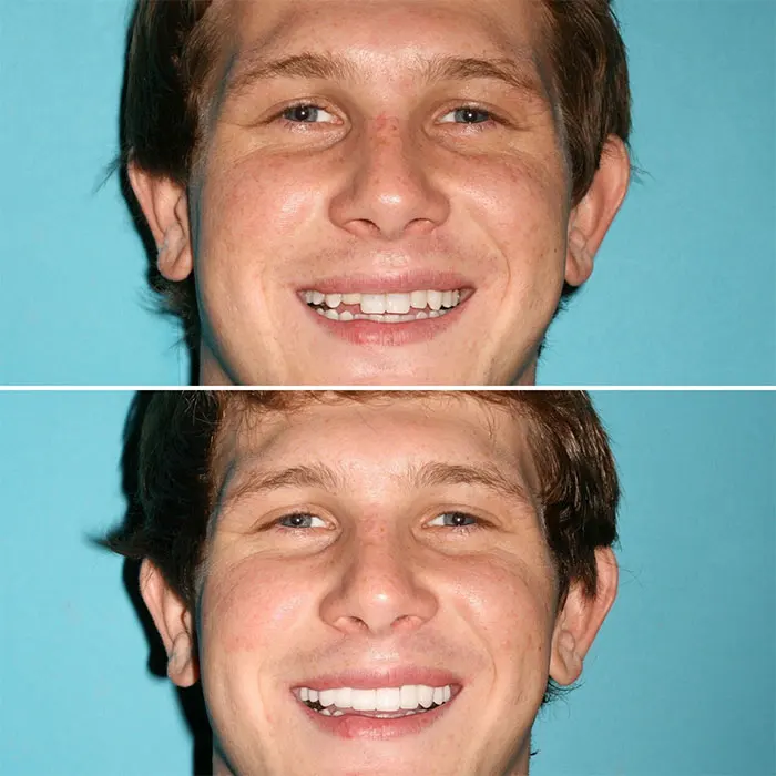 permanent dental veneers before and after (1)