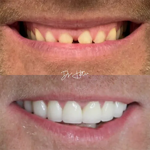 permanent dental veneers before and after (2)