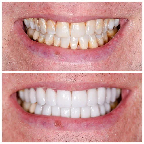permanent dental veneers before and after (3)