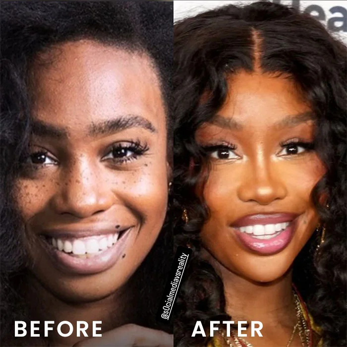 sza before and after face & nose surgery