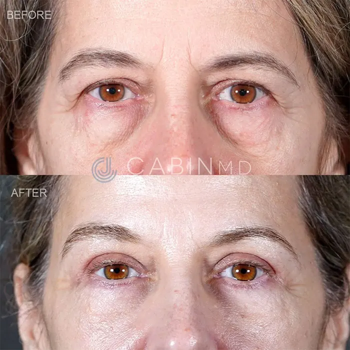three months after a full upper Blepharoplasty (1)