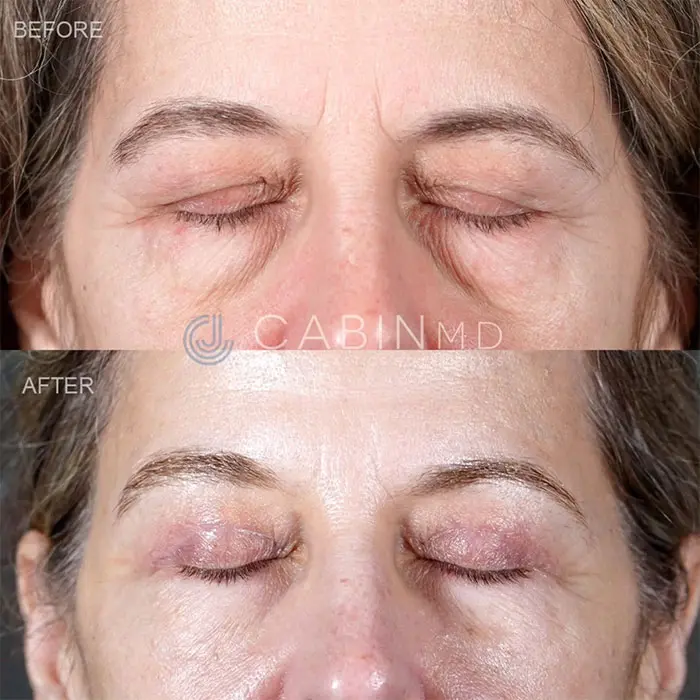 three months after a full upper Blepharoplasty (2)