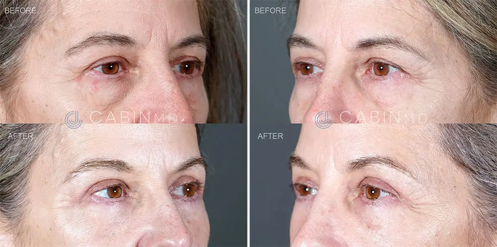 three months after a full upper Blepharoplasty (3)