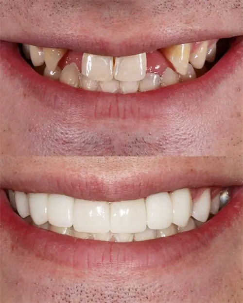 veneers before and after gaps