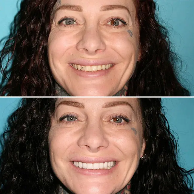 veneers before and after photos (1)