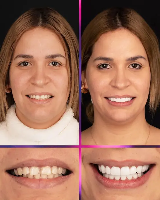 veneers before and after photos (2)