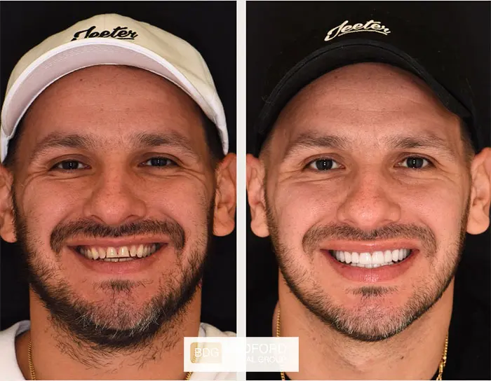 veneers before and after photos (5)