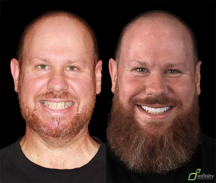veneers before and after photos men