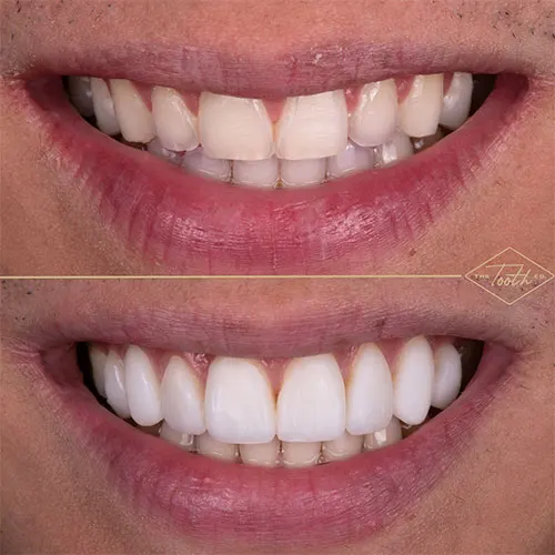 veneers before and after pictures