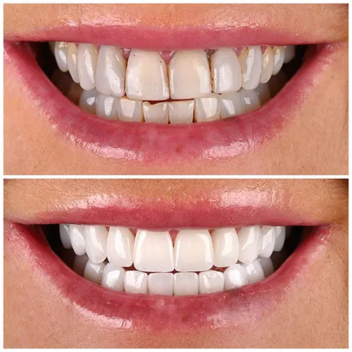 veneers before and after shaved (1)