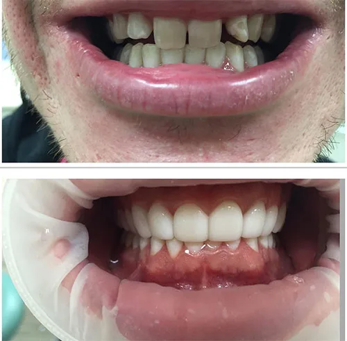 veneers before and after shaved (2)