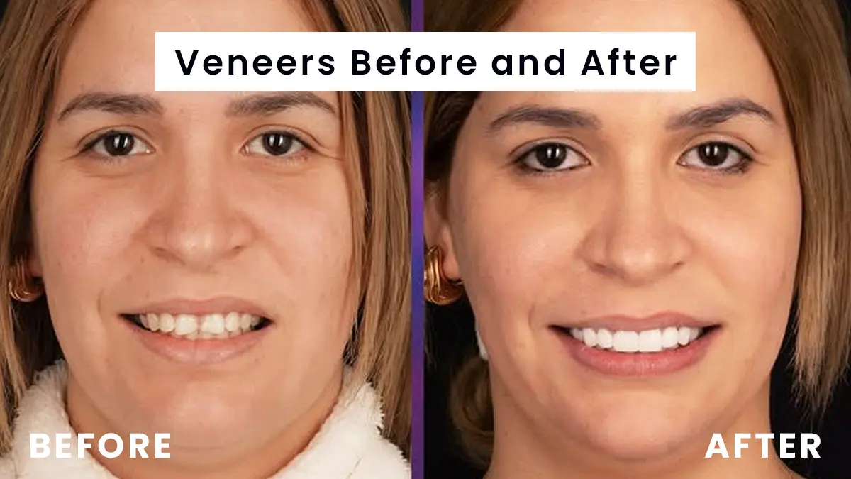 veneers before and after shaved (3)