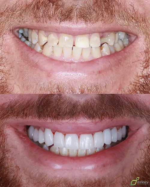 veneers before and after small teeth