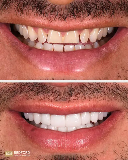 veneers before and after yellow teeth
